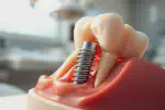 Comprehensive Guide to Root Canal Therapy